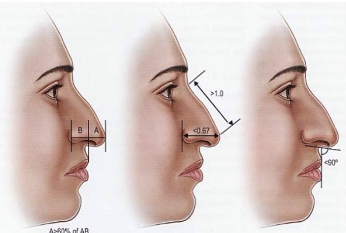 جراحات تجميل الأنف