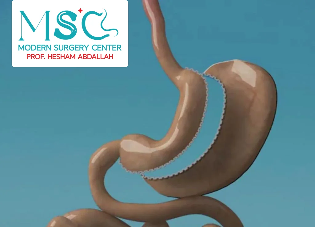 نسبة نجاح عملية تكميم المعدة