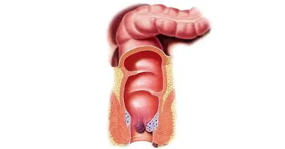 عملية-البواسير